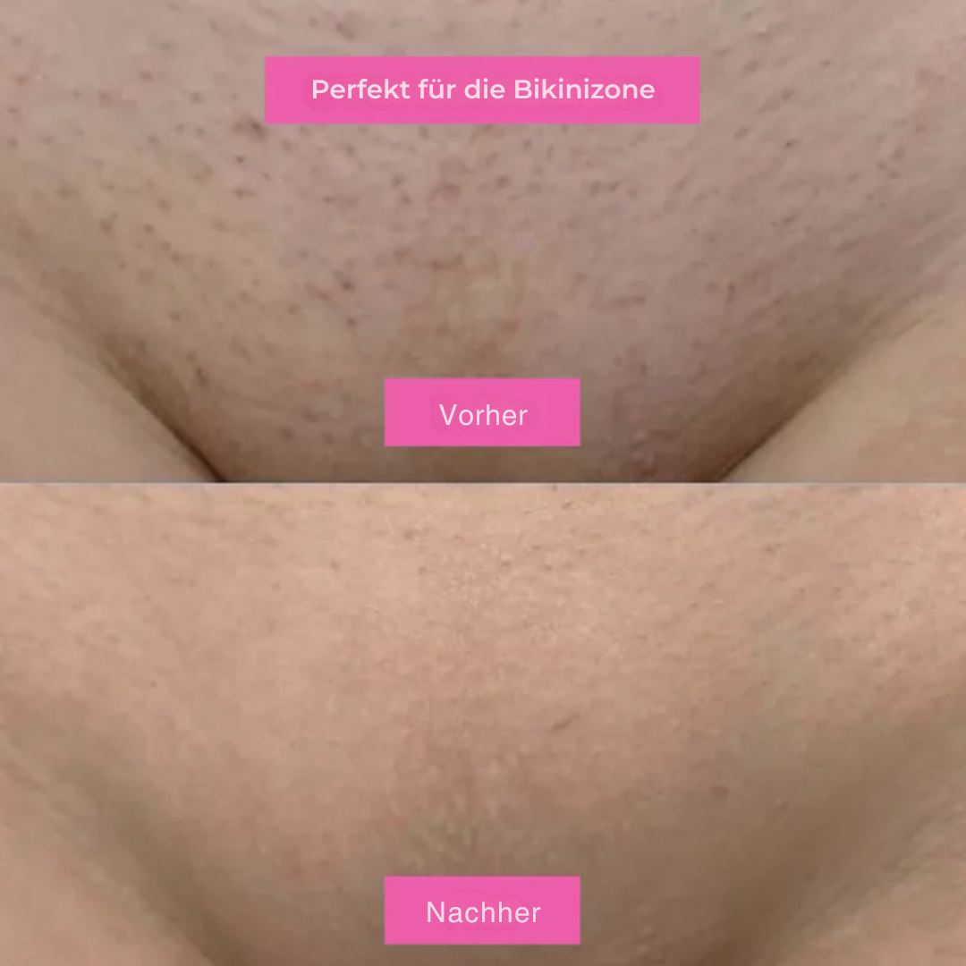 Haarentfernungsöl – Natürlich glatte Haut ohne Rasierer